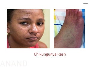 Chikungunya Rash
Dr N Anand
ANAND
 