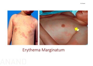Erythema Marginatum
Dr N Anand
ANAND
 