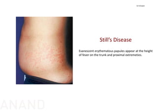 Still’s Disease
Evanescent erythematous papules appear at the height 
of fever on the trunk and proximal extremeties.
Dr N Anand
ANAND
 