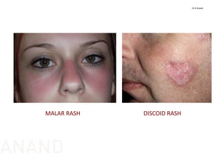 MALAR RASH DISCOID RASH
Dr N Anand
ANAND
 
