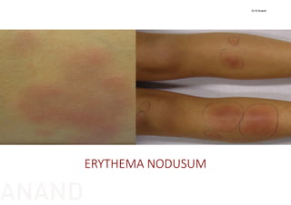 ERYTHEMA NODUSUM
Dr N Anand
ANAND
 