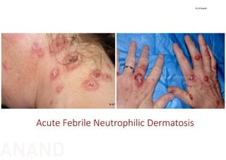 Acute Febrile Neutrophilic Dermatosis
Dr N Anand
ANAND
 