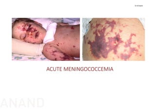ACUTE MENINGOCOCCEMIA
Dr N Anand
ANAND
 