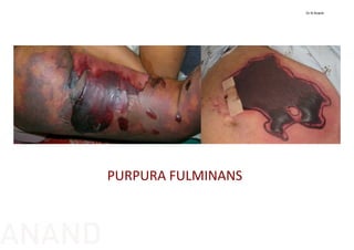 PURPURA FULMINANS
Dr N Anand
ANAND
 