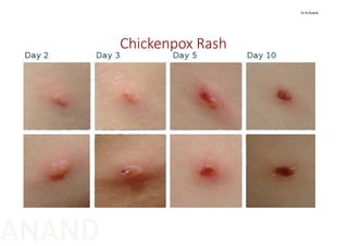 Chickenpox Rash
Dr N Anand
ANAND
 