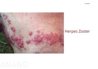 Herpes Zoster
Dr N Anand
ANAND
 