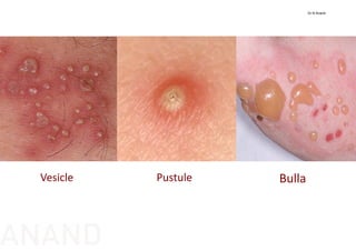 Vesicle Pustule Bulla
Dr N Anand
ANAND
 