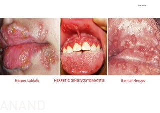 Genital HerpesHerpes Labialis HERPETIC GINGIVOSTOMATITIS
Dr N Anand
ANAND
 