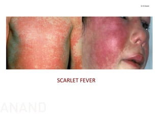 SCARLET FEVER
Dr N Anand
ANAND
 