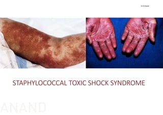 STAPHYLOCOCCAL TOXIC SHOCK SYNDROME
Dr N Anand
ANAND
 