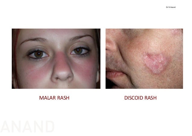 Fever With Rash