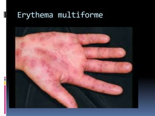 Erythema multiforme
 