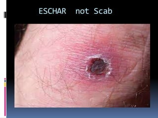 ESCHAR not Scab
 