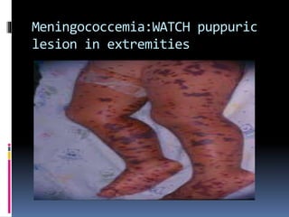Meningococcemia:WATCH puppuric
lesion in extremities
 