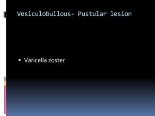 Vesiculobullous- Pustular lesion
 Varicella zoster
 