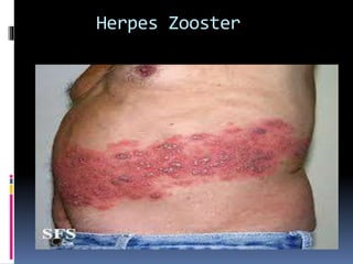 Herpes Zooster
 