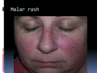 Malar rash
 