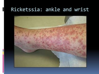 Ricketssia: ankle and wrist
 