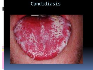 Candidiasis
 