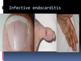 Infective endocarditis
 