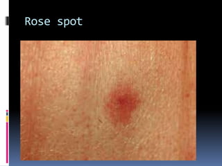Rose spot
 