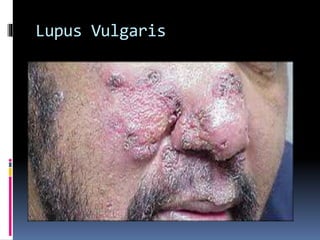 Lupus Vulgaris
 