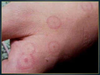 Fever with rash in dermatology. | PPTX