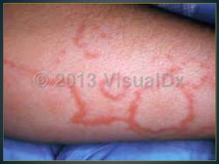 Fever with rash in dermatology. | PPTX