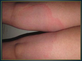 Fever with rash in dermatology. | PPTX