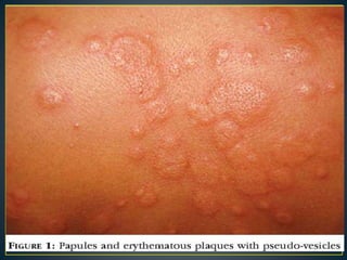 Fever Related Rash Fever with rash in dermatology. | PPTX