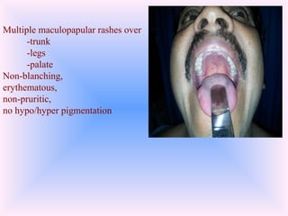 Fever with rash | PPT