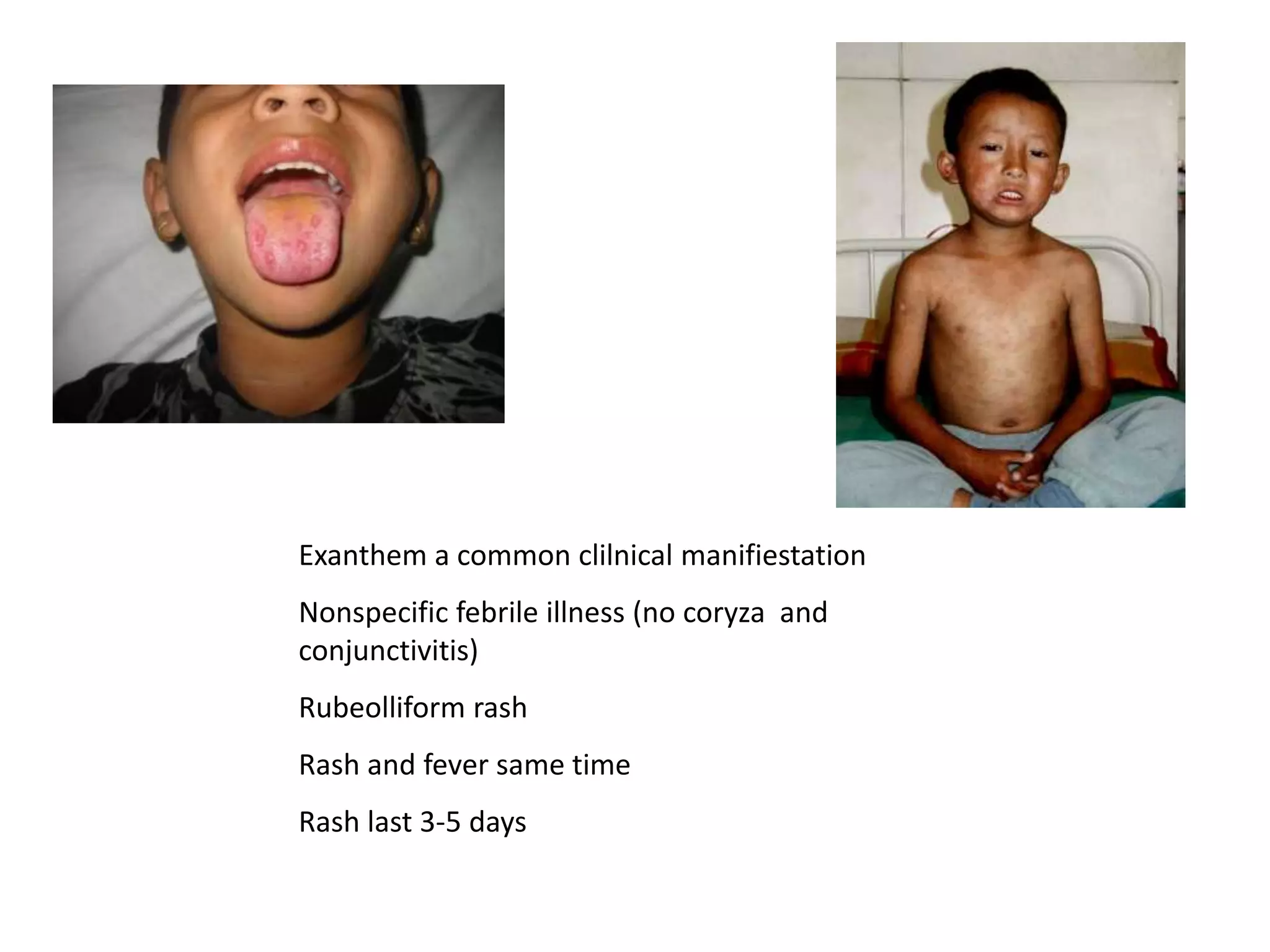 Pfb Rash Fever with rash | PPT