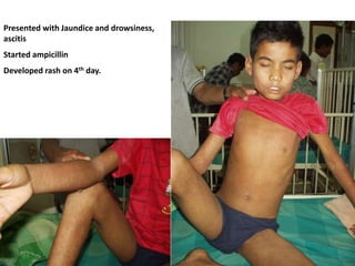 Presented with Jaundice and drowsiness,
ascitis
Started ampicillin
Developed rash on 4th day.
 