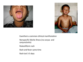 Exanthem a common clilnical manifiestation
Nonspecific febrile illness (no coryza and
conjunctivitis)
Rubeolliform rash
Rash and fever same time
Rash last 3-5 days
 