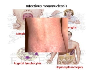 Mono Rash In Children Fever with rash - Diagnosis and Treatment | PPTX