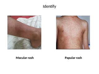 Pfb Rash Fever with rash - Diagnosis and Treatment | PPTX