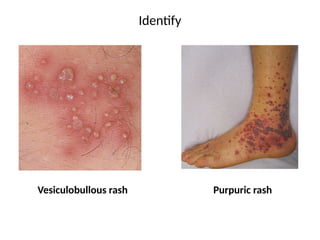 Fever with rash - Diagnosis and Treatment | PPTX