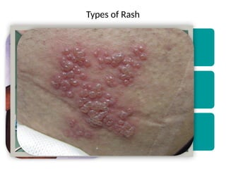 Herman S Rash Fever with rash - Diagnosis and Treatment | PPTX