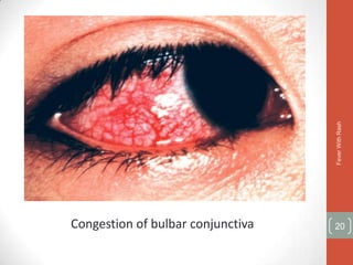 Fever With Rash
Congestion of bulbar conjunctiva   20
 