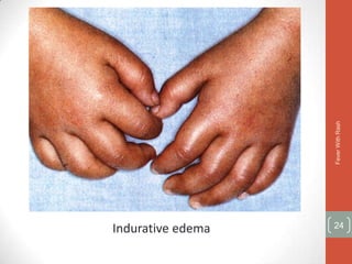 Fever With Rash
Indurative edema   24
 
