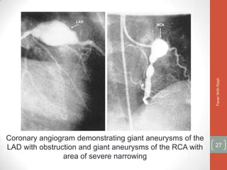 Fever With Rash
Coronary angiogram demonstrating giant aneurysms of the
LAD with obstruction and giant aneurysms of the RCA with   27

                area of severe narrowing
 