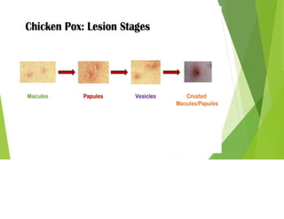 Fever with rashes, decribing various types of fever presenting with ...