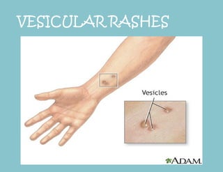 Fever with Rashes DIFFERENTIAL DIAGNOSIS | PPTX