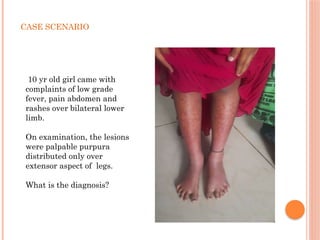Bilateral Extensor Surface Rash fever with rash final ppt and it's management.pptx