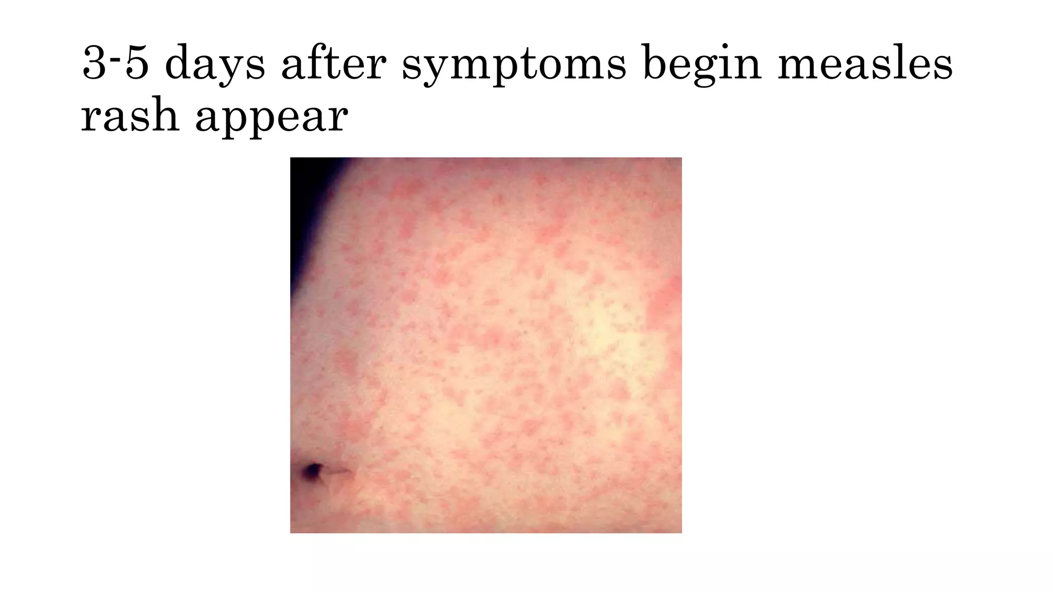 Fever with rash in children | PPTX