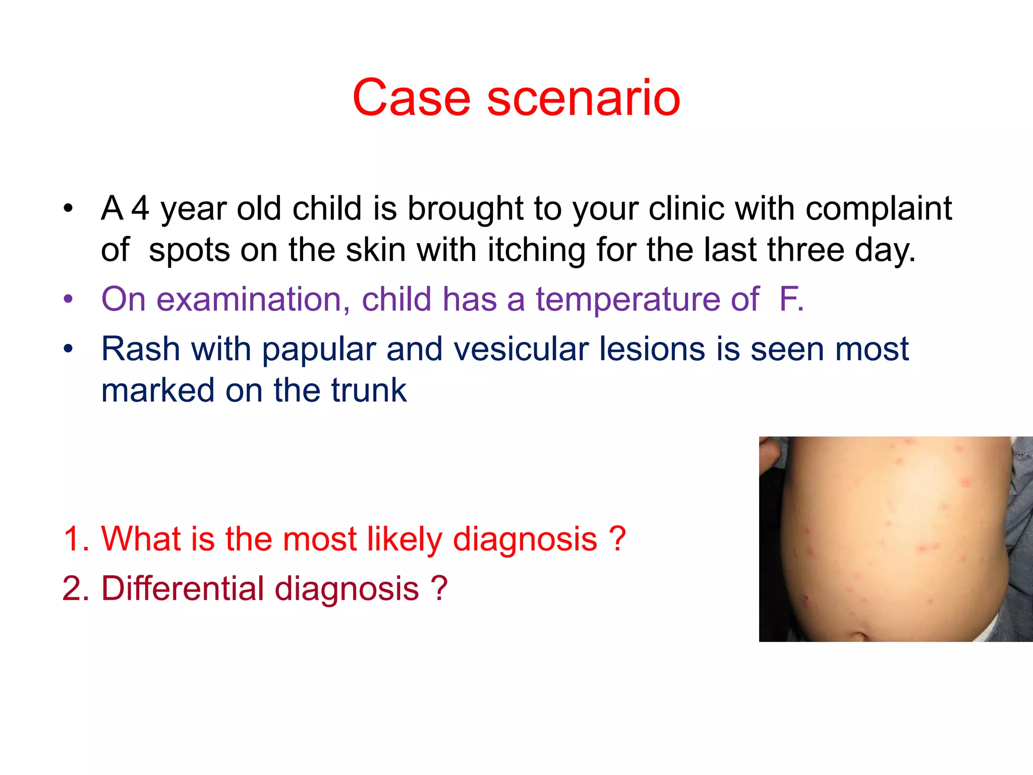 Fever with vesicular skin rash in children 2021 | PDF