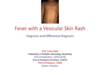Fever with a Vesicular Skin Rash
Diagnosis and Differential Diagnosis
Prof. Imran Iqbal
Fellowship in Pediatric Neurology (Australia)
Prof of Paediatrics (2003-2018)
Prof of Pediatrics Emeritus, CHICH
Prof of Pediatrics, CIMS
Multan, Pakistan
 