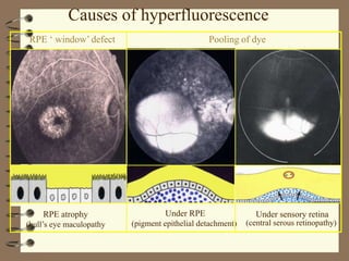 FUNDUS FLUORESCEIN ANGIOGRAPHY | PPTX