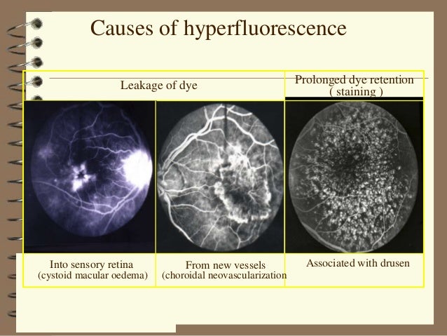 FUNDUS FLUORESCEIN ANG...