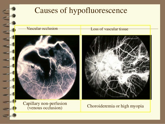 FUNDUS FLUORESCEIN ANGIOGRAPHY FUNDUS FLUORESCEIN ANGIOGRAPHY